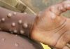 Monkeypox outbreak can still be contained, insists UN health agency