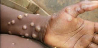 Monkeypox outbreak can still be contained, insists UN health agency