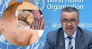 Monkeypox declared a global health emergency by the World Health Organisation