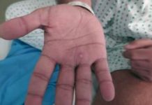 Monkeypox concern heightened after becoming a ‘northern’ disease, says WHO