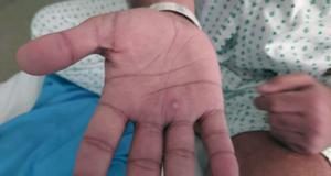 Monkeypox concern heightened after becoming a ‘northern’ disease, says WHO