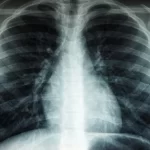 Western Pacific governments urged to speed up action to end TB in the region