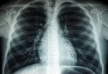 Western Pacific governments urged to speed up action to end TB in the region
