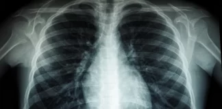 Western Pacific governments urged to speed up action to end TB in the region