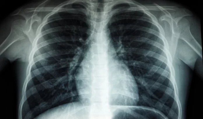 Western Pacific governments urged to speed up action to end TB in the region